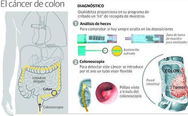 ¿Debemos comenzar el cribado de cáncer de colon antes de los 50 años?